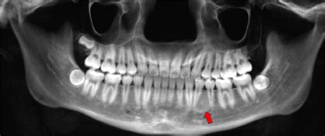 Fibroma Osificante
