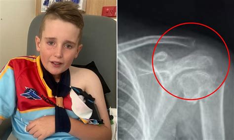 See the shocking moment boy, 12, has his shoulder shattered by ...