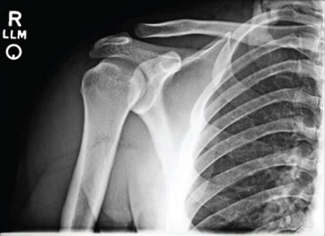 Rib Fracture On Ct Scan at Alica Martel blog