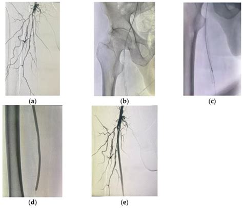 Comparative Study between Mechanical Rotational Atherectomy Combined ...