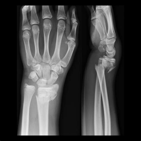 Colles Fracture