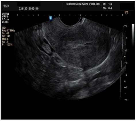 The Role of Ultrasound in Diagnosing Endometrial Pathologies: Adherence to IETA Group Consensus ...