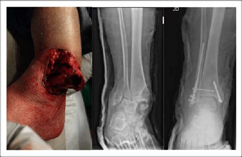 Open ankle fracture with a medial tear with significant displacement ...