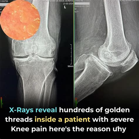 X-rays Reveal Hundreds of Golden Threads Inside a Patient with Severe Knee Pain — Here’s the ... - why is called x ray