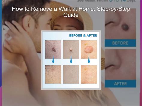 How to Remove a Wart at Home: Step-by-Step Guide – KentDO™ Healthy & Beauty