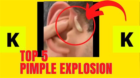 Image result for Large Pimples Exploding