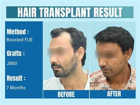 World's Best Hair Transplant Surgeon Result