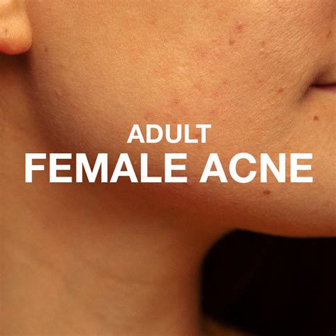 Adult Female Acne: Why It Happens & What Helps – Soulflower.in