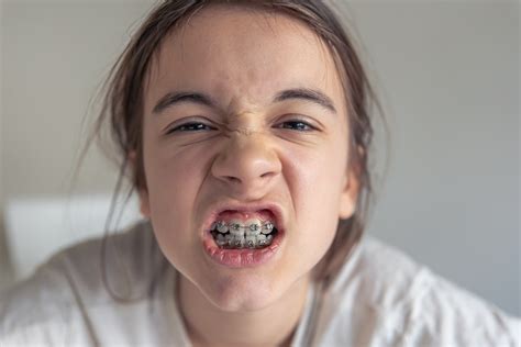 Dry Mouth With Braces: Causes, Symptoms, and Relief Tips