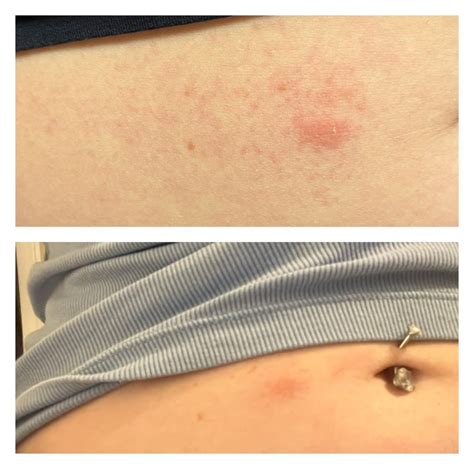 What is this red spot on my stomach? : r/DermatologyQuestions