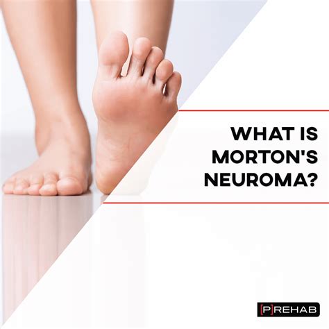 Morton's Neuroma Treatment Exercises - Quotes Trendy