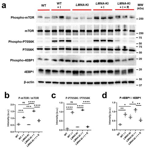 Personalized Medicine Approach in a DCM Patient with LMNA Mutation ...
