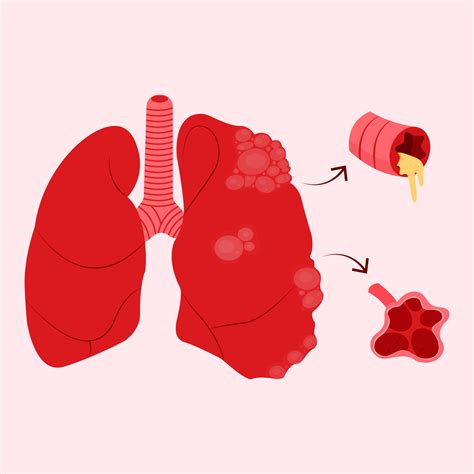 Copd Patient Clipart
