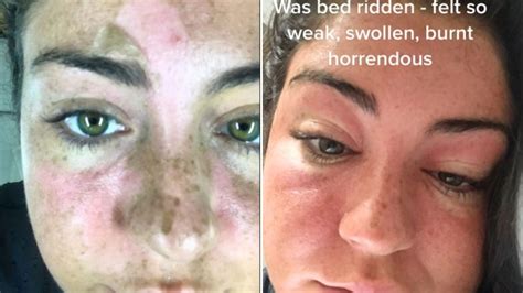 I was bed bound by a sunbed, I got face burns so bad I lost all my ...