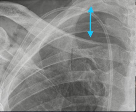 Image result for CVC Line Distal Port