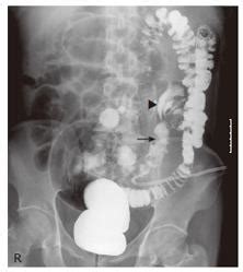 Bildergebnis für ruptured abscess on colon