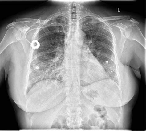 Portacath Placement | Chest X-Ray - MedSchool
