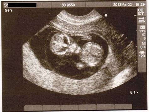 Image result for Alien Baby Ultrasound Scene