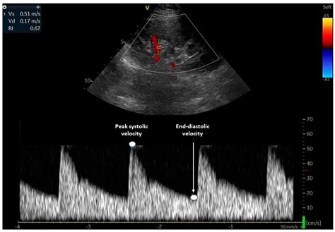 Current Insights into the Significance of the Renal Resistive Index in Kidney and Cardiovascular ...