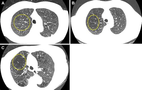 Emphysema at Baseline Low-Dose CT Lung Cancer Screening Predicts Death from Chronic Obstructive ...