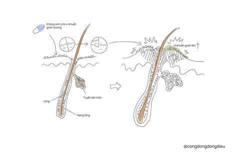 Bệnh viêm nang lông do vi khuẩn Gram Âm (Gram-negative folliculitis - GNF)