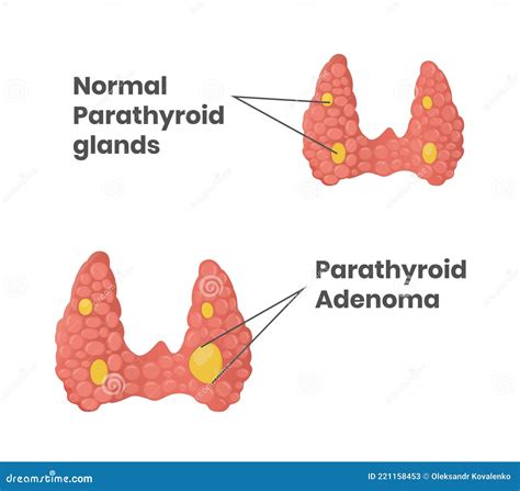 Normal Parathyroid Glands with Parathyroid Adenoma Stock Vector ...