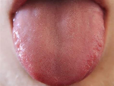 舌 の 病気 写真 - Hello Doctor