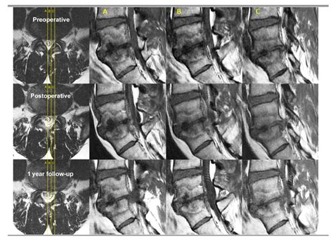 Lumbar Degenerative Disease Part 1: Anatomy and Pathophysiology of Intervertebral Discogenic ...