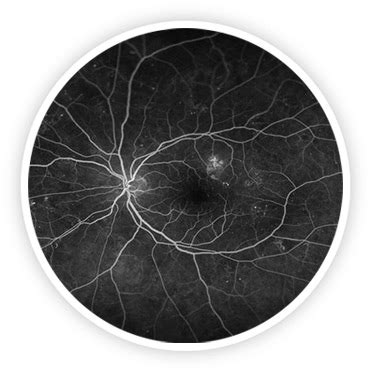 Retina, Vítreo y Uveítis - Dr. T. X. Lertxundi Plaza