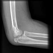 Image result for Fractured Elbow with Tendon Rupture