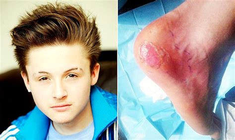 Blister On Foot Infected