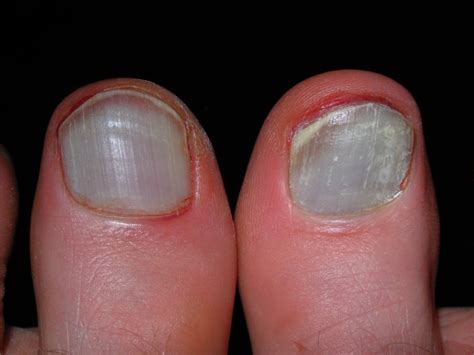 Kuvatulokset haulle blood blister