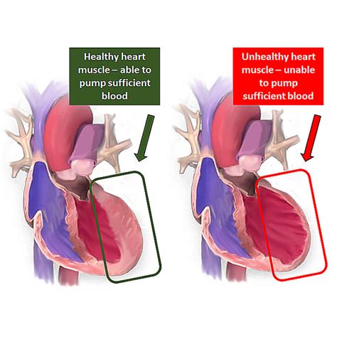 Congestive Heart Failure - CarePlanIt