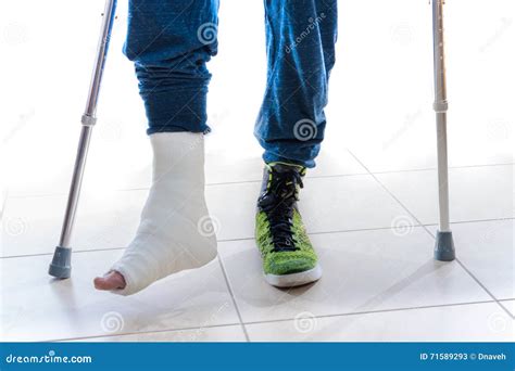 Broken Ankle Cast With Crutches