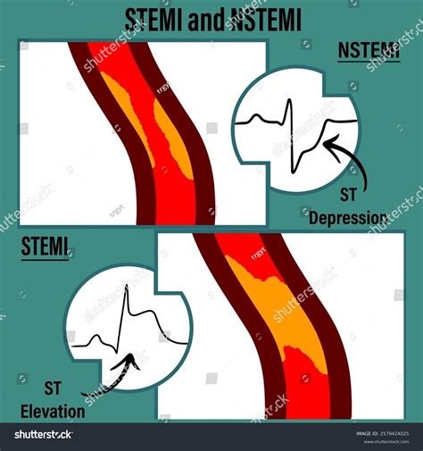 Stemi Vs Nstemi Comparative Visual Guide Stock Illustration 2579424025 ...