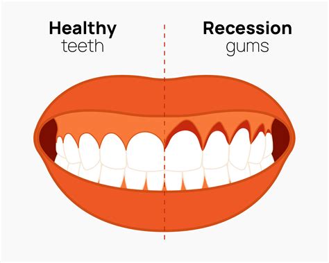 Gum Tissue Graft Cost With Insurance at Rocio Wilds blog