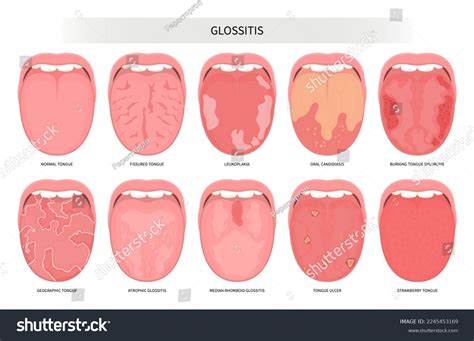Median Rhomboid Glossitis Histology