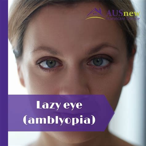 Lazy eye amblyopia symptoms and causes – Artofit