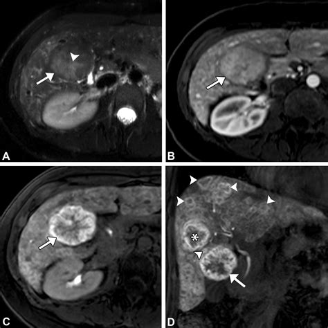 Focal Nodular Hyperplasia and Focal Nodular Hyperplasia–like Lesions | RadioGraphics