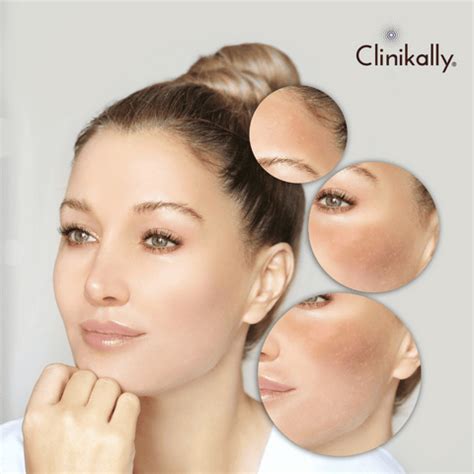 Navigating Melasma Management: Unveiling the Importance |Clinikally|