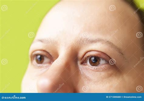 Barley In Jaundice at Jasmine Bowe blog