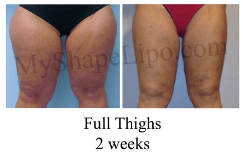 liposuction recovery - Liposuction - Vaser Lipo