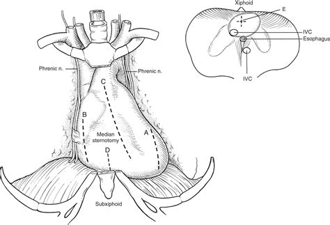 Pertinent surgical anatomy of the thorax and mediastinum - Clinical Tree