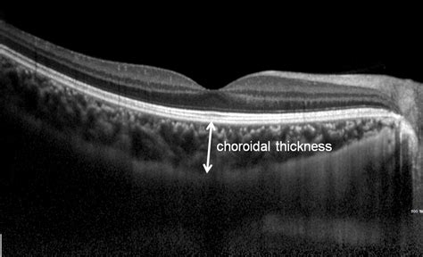 An Optometrist's Guide to Pachychoroid Spectrum Conditions