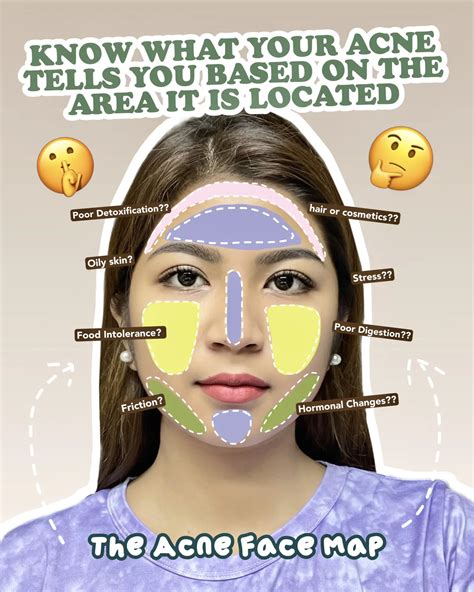 Acne Face Map: What causes your acne?🤔💯 | Gallery posted by Sandra | Lemon8