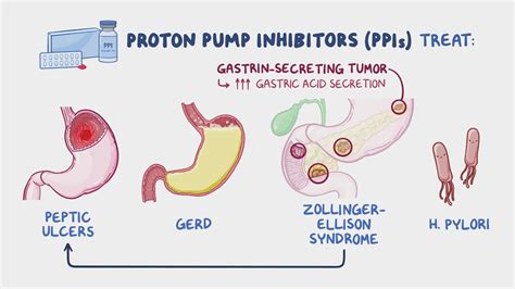 Proton pump inhibitor use in older adults: long-term risks and, proton ...
