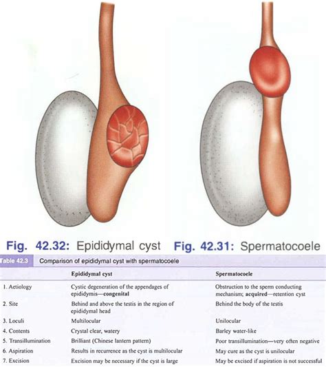 Epididymal Cyst