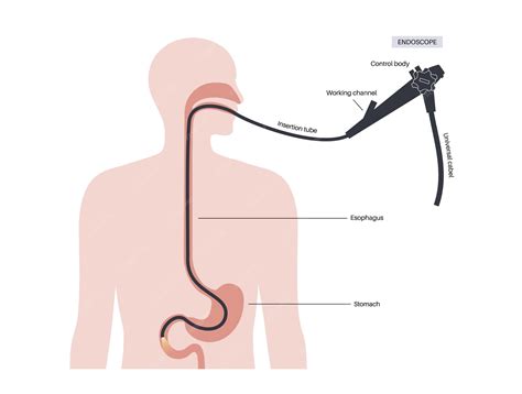 Premium Vector | Esophagogastroduodenoscopy medical poster diagnostic ...
