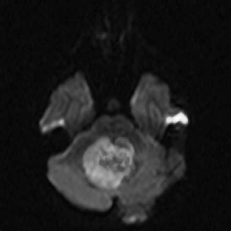 Imaging Characteristics of Atypical Teratoid–Rhabdoid Tumor in Children Compared with ...