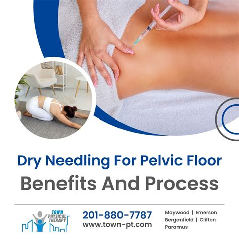Dry Needling for Pelvic Floor Dysfunction: A Comprehensive Guide | Town ...